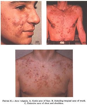 Acne Vulgaris: A: Cystic acne on the face, B: ...